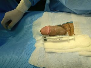 Tăng kích thước dương vật bằng mô da nhân tạo, đường mổ ở mu, khách hàng 30 tuổi HCM - ca 95