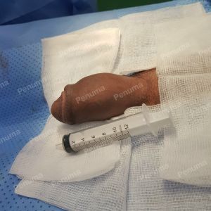 Tăng kích thước dương vật bằng mô da nhân tạo, đường mổ ở mu, khách hàng 46 tuổi Nha Trang - ca 91