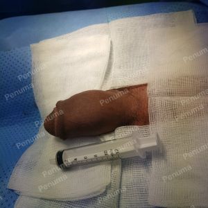 Tăng kích thước dương vật bằng mô da nhân tạo, đường mổ ở mu, khách hàng 46 tuổi Nha Trang - ca 91