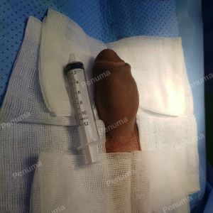 Tăng kích thước dương vật bằng mô da nhân tạo, đường mổ ở mu, khách hàng 46 tuổi Nha Trang - ca 91