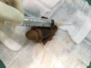 Tăng kích thước dương vật bằng mô da nhân tạo, đường mổ ở mu, khách hàng 38 tuổi Lào Cai - ca 93