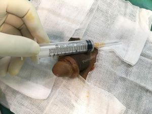 Tăng kích thước dương vật bằng mô da nhân tạo, đường mổ ở mu, khách hàng 38 tuổi Lào Cai - ca 93