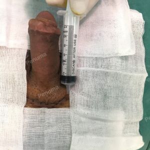 Tăng kích thước dương vật bằng mô da nhân tạo, đường mổ ở mu, khách hàng 38 tuổi Lào Cai - ca 93