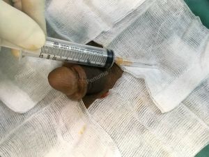 Tăng kích thước dương vật bằng mô da nhân tạo, đường mổ ở mu, khách hàng 38 tuổi Lào Cai - ca 93