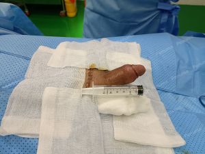 Độn dương vật bằng mô da nhân tạo, đường mổ ở mu, khách hàng 33 tuổi Đồng Nai - ca 94