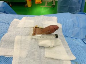 Độn dương vật bằng mô da nhân tạo, đường mổ ở mu, khách hàng 33 tuổi Đồng Nai - ca 94