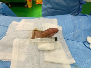 Độn dương vật bằng mô da nhân tạo, đường mổ ở mu, khách hàng 33 tuổi Đồng Nai - ca 94