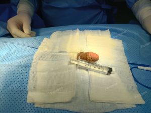 Độn dương vật bằng mô da nhân tạo, đường mổ ở mu, khách hàng 33 tuổi Đồng Nai - ca 94