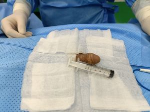 Độn dương vật bằng mô da nhân tạo, đường mổ ở mu, khách hàng 33 tuổi Đồng Nai - ca 94