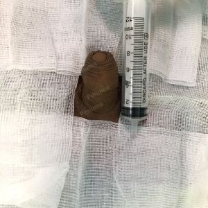 Độn dương vật bằng mô da nhân tạo, đường mổ ở mu, khách hàng 38 tuổi Thái Bình - ca 108