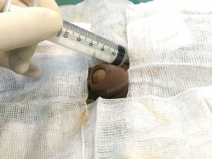 Độn dương vật bằng mô da nhân tạo, đường mổ ở mu, khách hàng 38 tuổi Thái Bình - ca 108