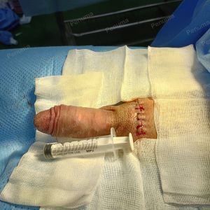 Tăng kích thước dương vật bằng mô da nhân tạo, đường mổ ở mu, khách hàng 30 tuổi Phú Quốc - ca 105
