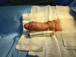 Tăng kích thước dương vật bằng mô da nhân tạo, đường mổ ở mu, khách hàng 30 tuổi Phú Quốc - ca 105