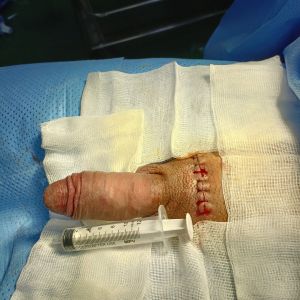 Tăng kích thước dương vật bằng mô da nhân tạo, đường mổ ở mu, khách hàng 30 tuổi Phú Quốc - ca 105