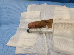 Tăng kích thước dương vật bằng mô da nhân tạo, đường mổ ở mu, khách hàng 30 tuổi Phú Quốc - ca 105