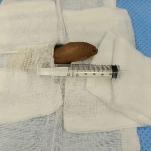 Độn dương vật bằng mô da nhân tạo, đường mổ ở mu, khách hàng 33 tuổi Bình Phước - ca 104