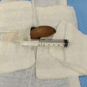 Độn dương vật bằng mô da nhân tạo, đường mổ ở mu, khách hàng 33 tuổi Bình Phước - ca 104