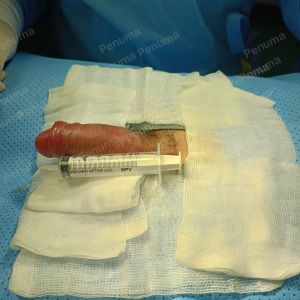 Độn dương vật bằng mô da nhân tạo, đường mổ ở mu, khách hàng 33 tuổi Bình Phước - ca 104