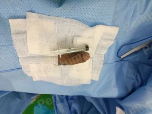 Độn dương vật bằng mô da nhân tạo, đường mổ ở mu, khách hàng 38 tuổi Bình Dương - ca 102