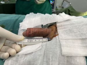 Tăng kích thước cậu nhỏ bằng tấm độn sinh học megaderm , đường mổ ở mu, khách hàng 39 tuổi, Vĩnh Phúc - ca 124