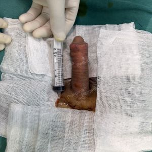 Tăng kích thước cậu nhỏ bằng tấm độn sinh học megaderm , đường mổ ở mu, khách hàng 39 tuổi, Vĩnh Phúc - ca 124