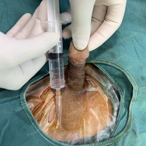 Tăng kích thước cậu nhỏ bằng tấm độn sinh học megaderm , đường mổ ở mu, khách hàng 39 tuổi, Vĩnh Phúc - ca 124