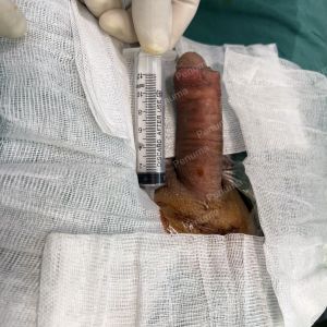 Tăng kích thước cậu nhỏ bằng tấm độn sinh học megaderm , đường mổ ở mu, khách hàng 39 tuổi, Vĩnh Phúc - ca 124