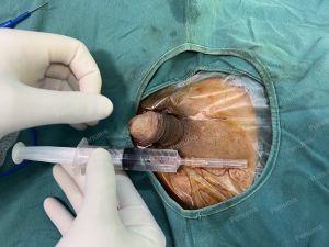 Tăng kích thước cậu nhỏ bằng tấm độn sinh học megaderm , đường mổ ở mu, khách hàng 39 tuổi, Vĩnh Phúc - ca 124