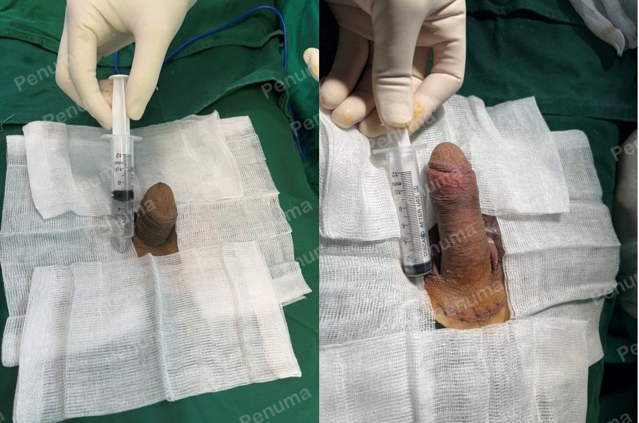 Tăng kích thước cậu nhỏ bằng tấm độn sinh học megaderm , đường mổ ở mu, khách hàng 64 tuổi, Hà Nội - ca 125