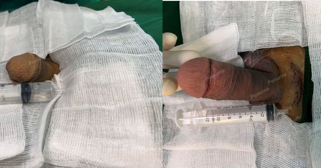 Độn dương vật bằng tấm độn megaderm , đường mổ ở mu, khách hàng 42 tuổi, Thanh Hóa - ca 126