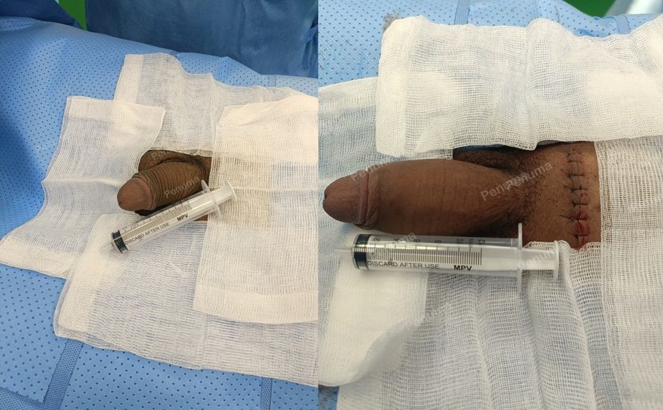 Tăng kích thước cậu nhỏ bằng tấm độn sinh học megaderm , đường mổ ở mu, khách hàng 33 tuổi, Đồng Nai - ca 127