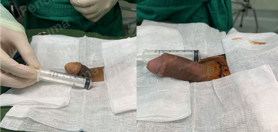 Độn dương vật bằng mô da nhân tạo, đường mổ ở mu, khách hàng 28 tuổi, Lào Cai - ca 132