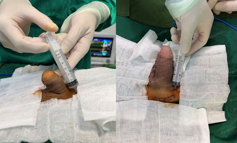 Tăng kích thước cậu nhỏ bằng tấm độn megaderm, đường mổ ở mu, khách hàng 50 tuổi, Hà Nội - ca 133