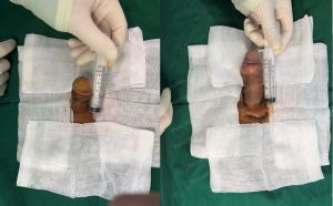 Độn dương vật bằng mô da nhân tạo, đường mổ ở mu, khách hàng 47 tuổi, Hà Nội - ca 134