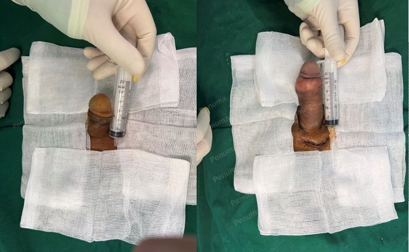 Độn dương vật bằng mô da nhân tạo, đường mổ ở mu, khách hàng 47 tuổi, Hà Nội - ca 134