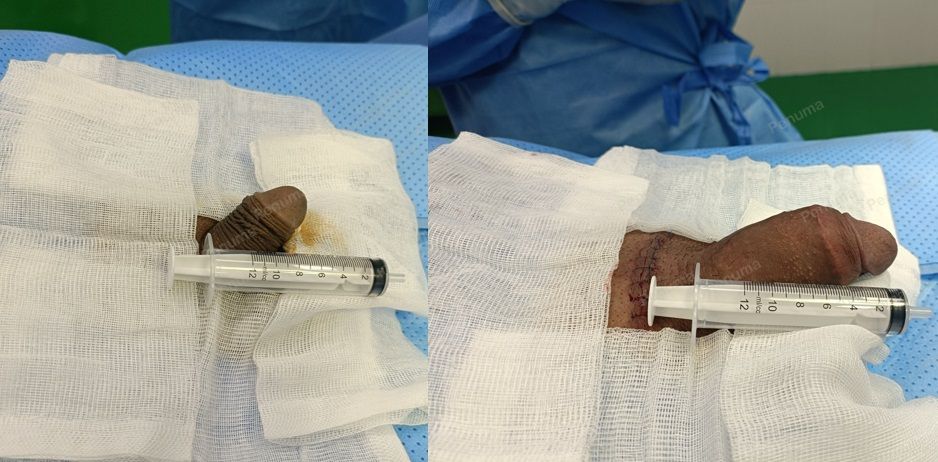 Tăng kích thước cậu nhỏ bằng tấm độn sinh học, đường mổ ở mu, khách hàng 30 tuổi, Daklak - ca 135