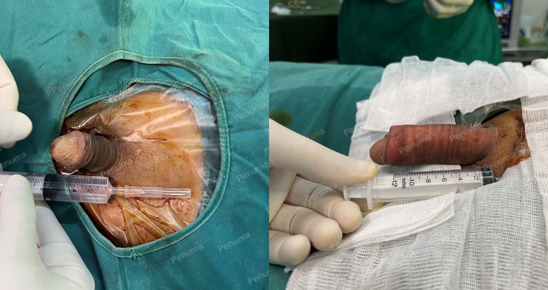 Tăng kích thước cậu nhỏ bằng tấm độn sinh học megaderm , đường mổ ở mu, khách hàng 39 tuổi, Vĩnh Phúc - ca 124