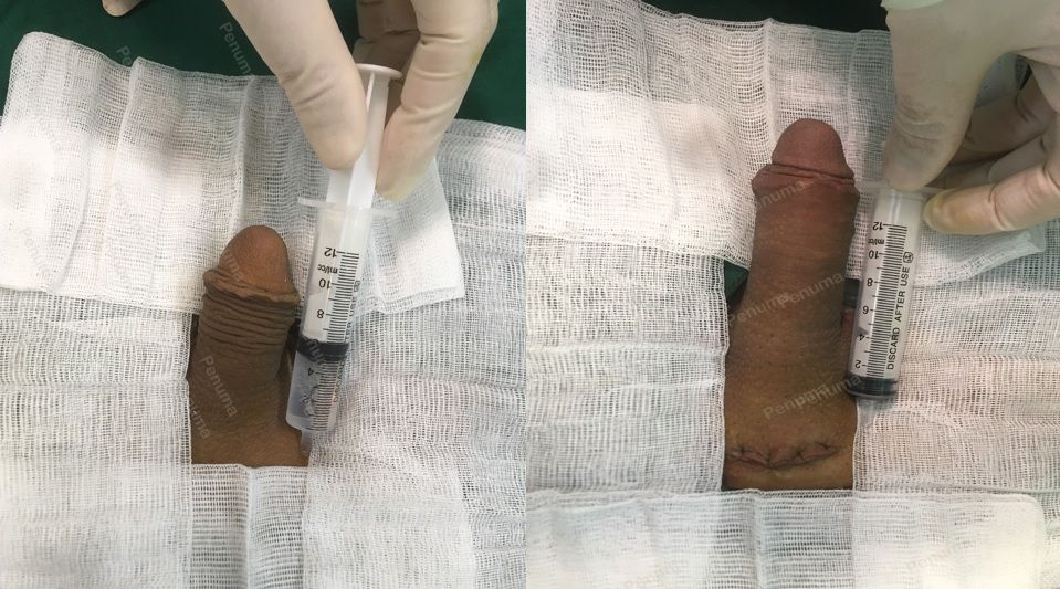 Độn dương vật bằng mô da nhân tạo, đường mổ ở mu, khách hàng 29 tuổi, Hà Nội - ca 128