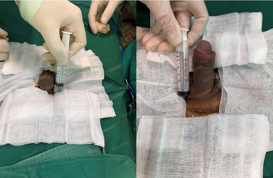 Tăng kích thước cậu nhỏ bằng tấm độn sinh học megaderm, đường mổ ở mu, khách hàng 35 tuổi, Điện Biên - ca 129