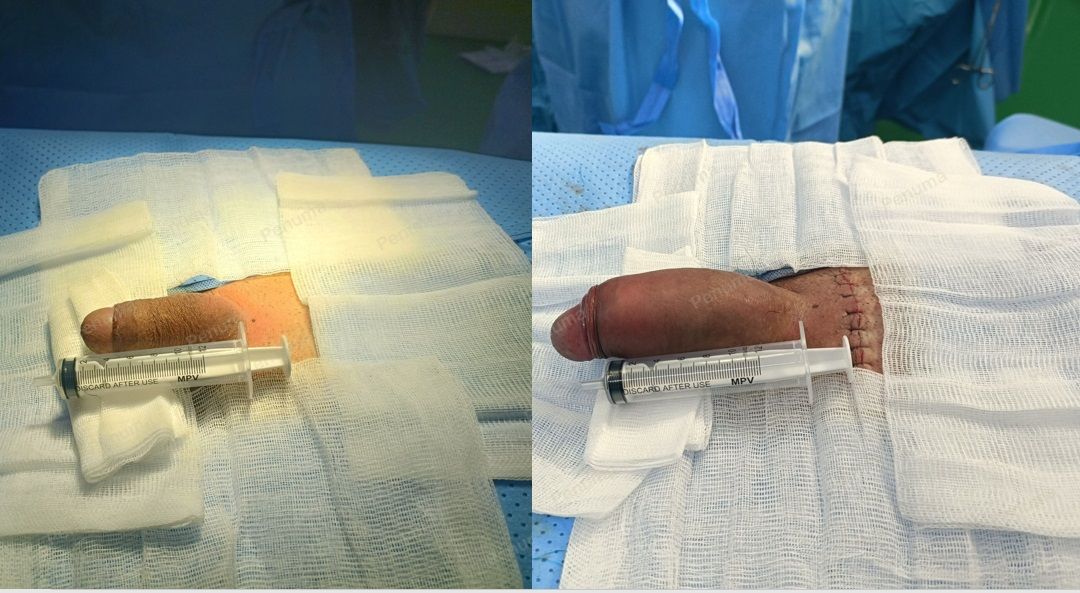 Độn dương vật bằng tấm độn megaderm, đường mổ ở mu, khách hàng 31 tuổi, Vũng Tàu - ca 130