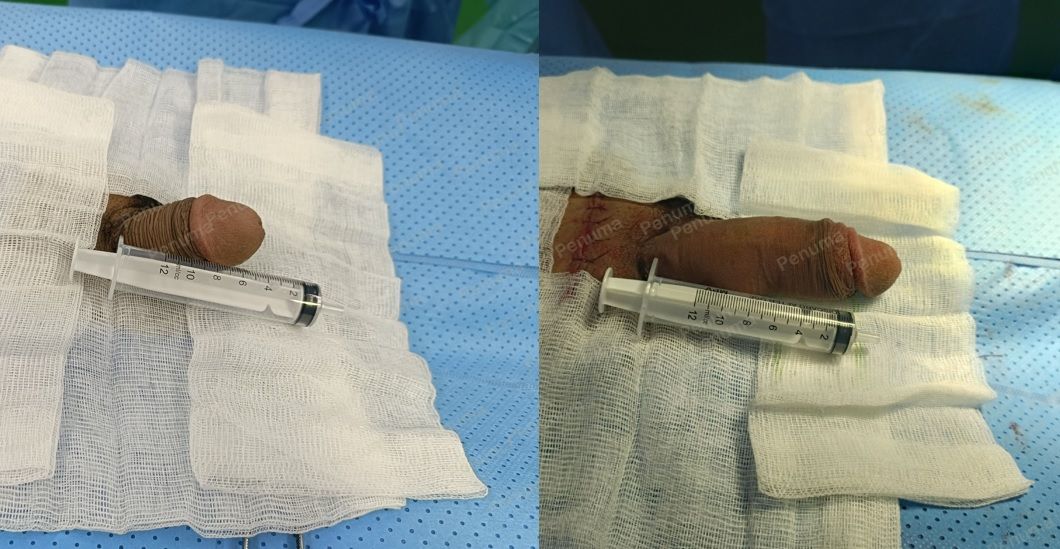 Tăng kích thước cậu nhỏ bằng tấm độn sinh học megaderm, đường mổ ở mu, khách hàng 32 tuổi, Gia Lai - ca 131