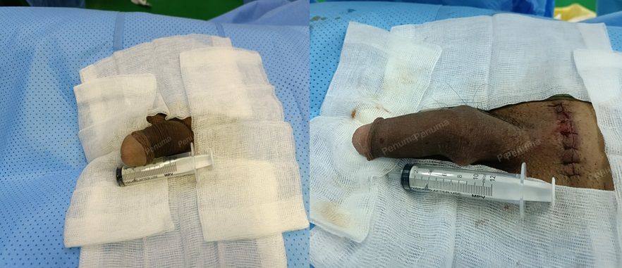 Độn dương vật bằng mô da nhân tạo, đường mổ ở mu, khách hàng 37 tuổi, Bình Phước - ca 136