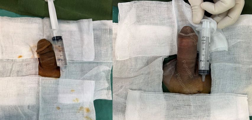 Tăng kích thước cậu nhỏ bằng tấm độn megaderm, đường mổ ở mu, khách hàng 35 tuổi, Hải Phòng - ca 137