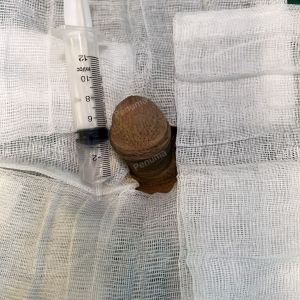 Độn dương vật bằng tấm độn megaderm , đường mổ ở mu, khách hàng 42 tuổi, Thanh Hóa - ca 126