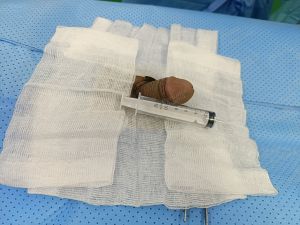 Tăng kích thước cậu nhỏ bằng tấm độn sinh học megaderm, đường mổ ở mu, khách hàng 32 tuổi, Gia Lai - ca 131