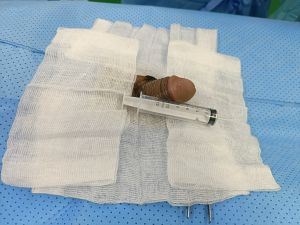 Tăng kích thước cậu nhỏ bằng tấm độn sinh học megaderm, đường mổ ở mu, khách hàng 32 tuổi, Gia Lai - ca 131