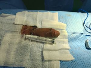 Tăng kích thước cậu nhỏ bằng tấm độn sinh học megaderm, đường mổ ở mu, khách hàng 32 tuổi, Gia Lai - ca 131