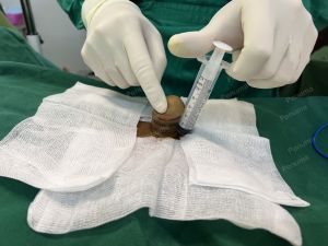 Độn dương vật bằng mô da nhân tạo, đường mổ ở mu, khách hàng 47 tuổi, Hà Nội - ca 134