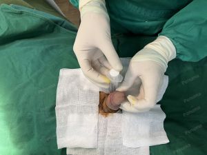 Độn dương vật bằng mô da nhân tạo, đường mổ ở mu, khách hàng 47 tuổi, Hà Nội - ca 134