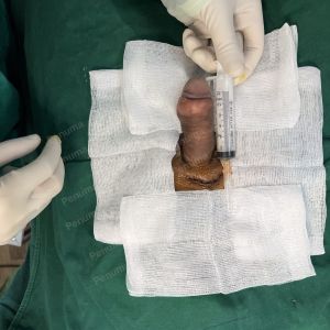 Độn dương vật bằng mô da nhân tạo, đường mổ ở mu, khách hàng 47 tuổi, Hà Nội - ca 134